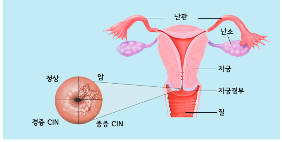 자궁·자궁경부 구조와 자궁경부암 병변