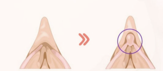 음핵수술 전후 비교