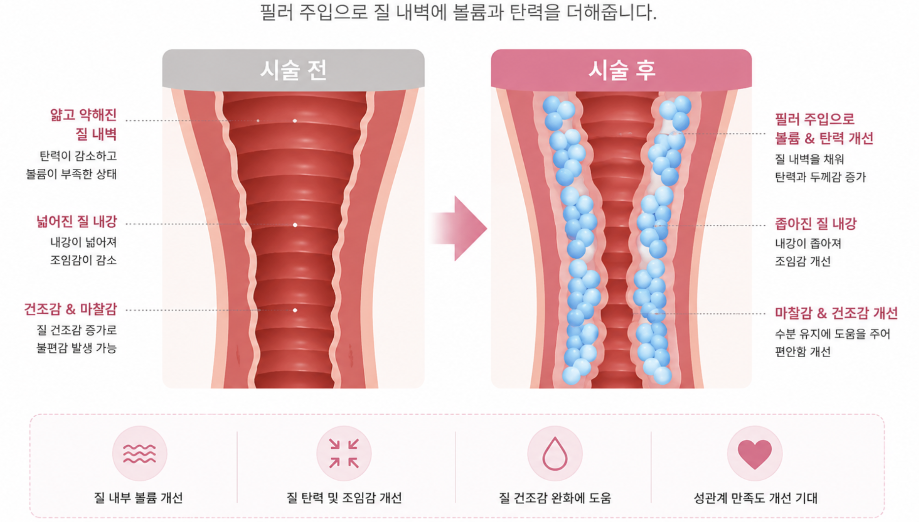 질필러 효과 - 시술 전후 비교