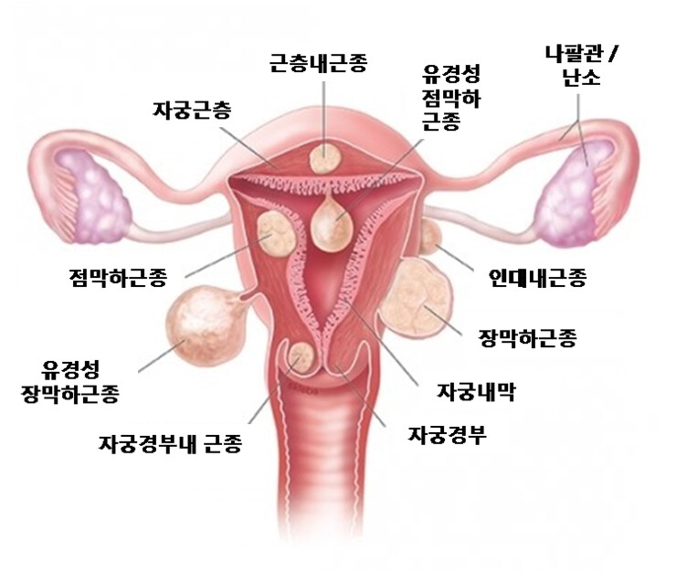 자궁근종 종류별 해부도