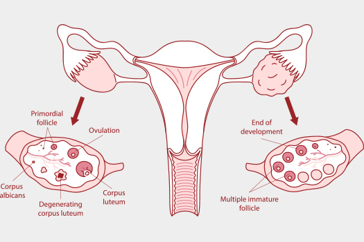 다낭성난소증후군