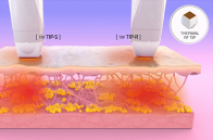 진피층에 Thermal RF 에너지 전달