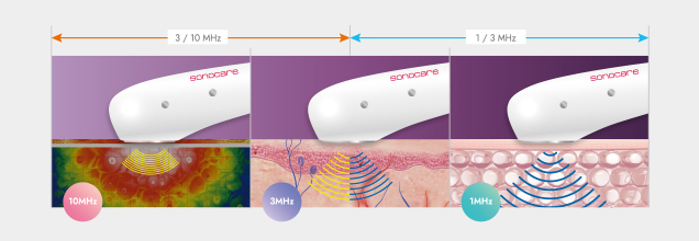 콜라겐 리모델링