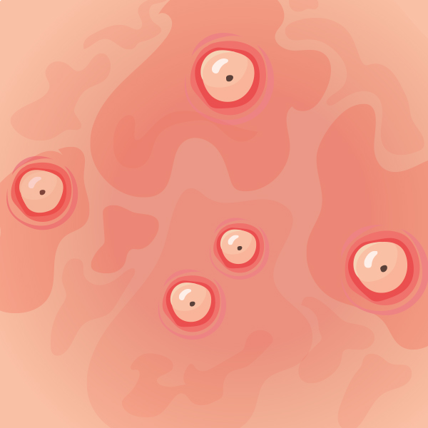 기타 외음부 낭종
